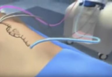 hipec χωρίς περιτοναϊκή διασπορά