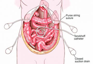 ενδοπεριτοναϊκή χημειοθεραπεία - tenckhoff