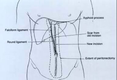 κυτταρομειωτική χειρουργική - επιγαστρική περιτοναιοεκτομή