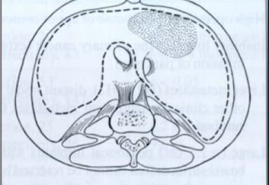 κυτταρομειωτική χειρουργική - υποδιαφραγματική περιτοναιοεκτομή