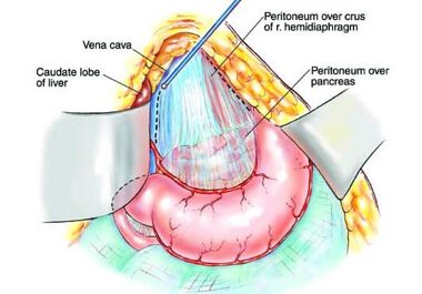 περιτοναϊκή κακοήθεια