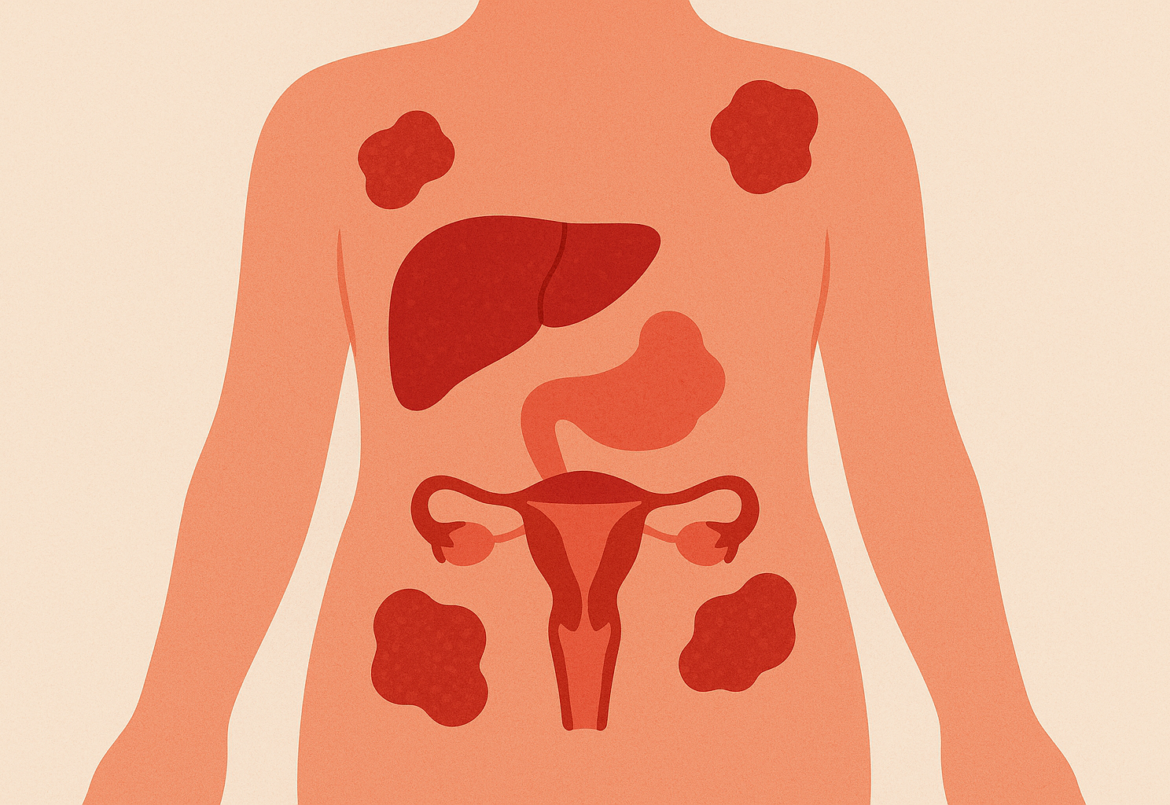 Εντόπιση των υποτροπών του καρκίνου των ωοθηκών