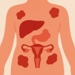 Εντόπιση των υποτροπών του καρκίνου των ωοθηκών